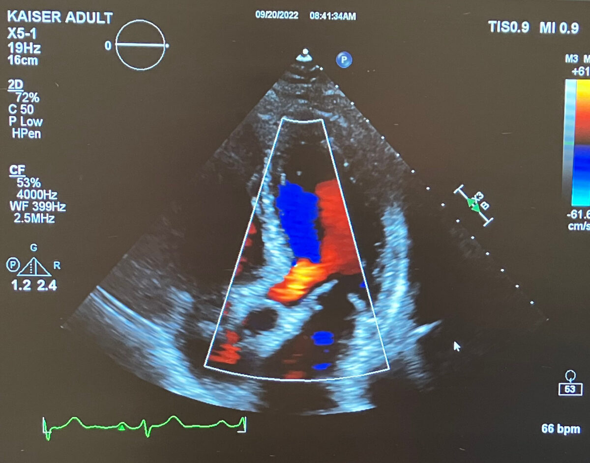 echocardiogram